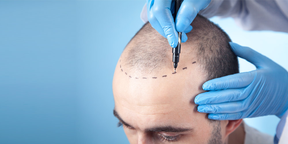 The best hair transplant in Jaipur provided by Dr Akangsha Sharma is a very effective hair restoration treatment with remarkable results.