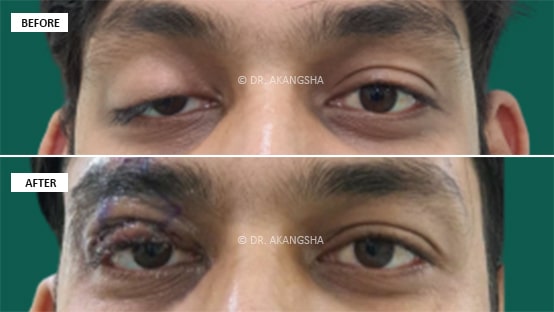 Upper Lid Ptosis Surgery before and after photos