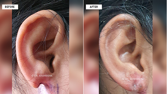 Ear Lobule Repair