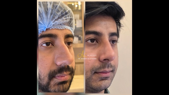 Rhinoplasty