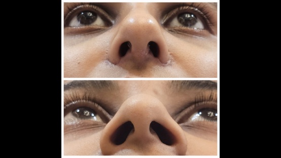 Rhinoplasty Before and After