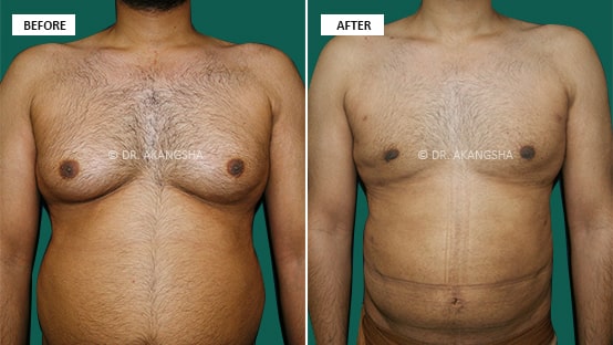 Male Chest/ Gynecomastia before and after photos