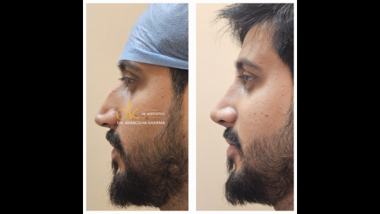 Rhinoplasty Before and After