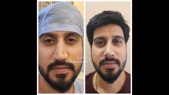 Rhinoplasty Before and After