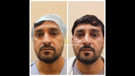 Rhinoplasty Before and After