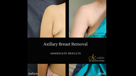 Axillary Breast