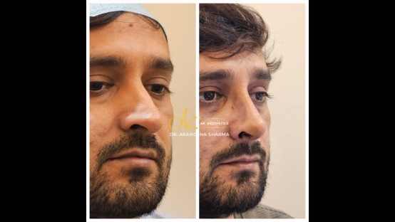 Rhinoplasty Before and After