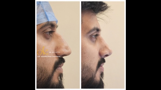 Rhinoplasty Before and After