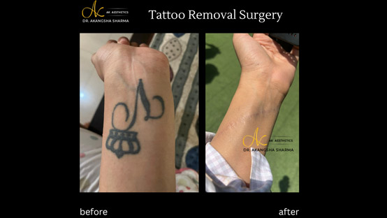 Tattoo Laser Removal | Pure Touch Aesthetic & Cosmetic Surgery Clinic