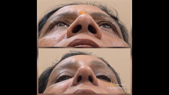 Rhinoplasty