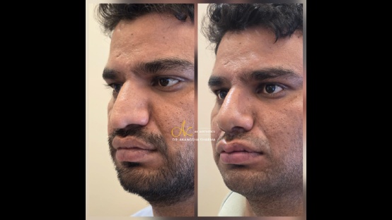 Rhinoplasty