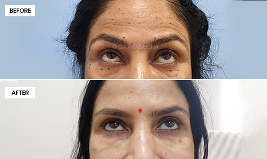Facial Anti Wrinkle Injections