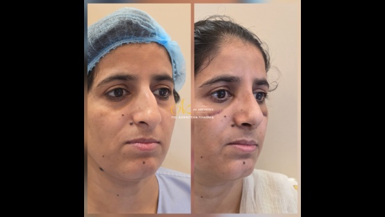 Rhinoplasty