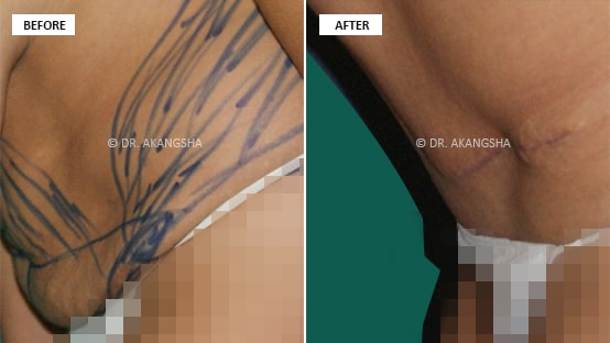Tummy Tuck before and after photos