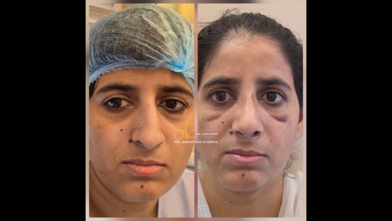 Rhinoplasty