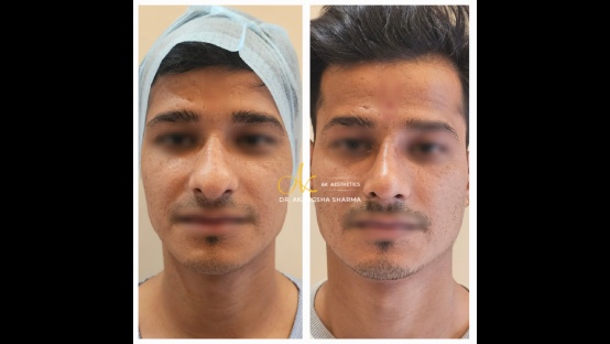 Rhinoplasty Before and After