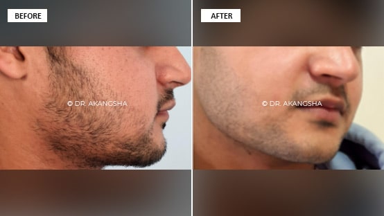 Buccal Fat Removal
