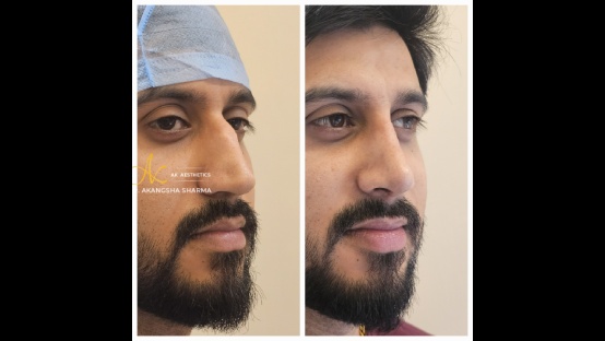Rhinoplasty Before and After