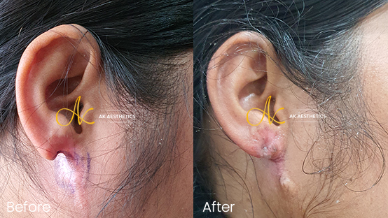 Ear lobule repair