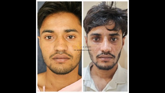 Rhinoplasty Before and After