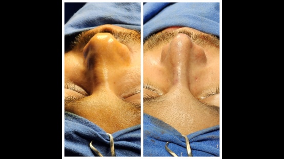 Rhinoplasty Before and After
