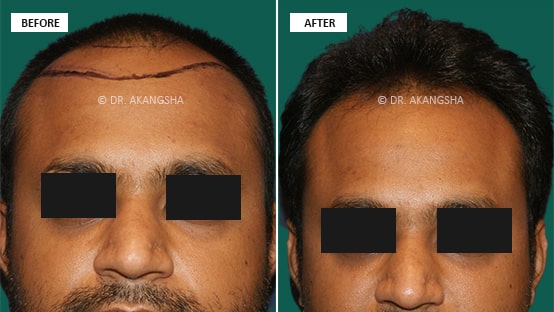 Hair Transplant before and after photos
