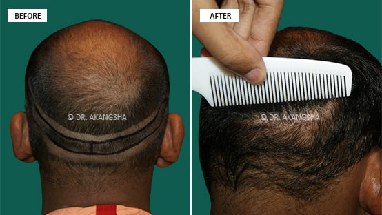 Hair Transplant before and after photos