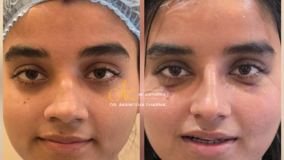 Rhinoplasty