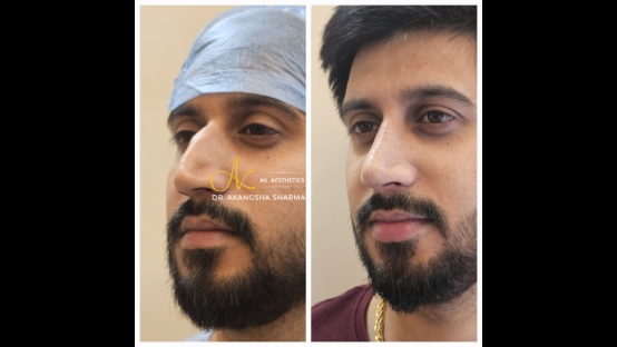 Rhinoplasty Before and After