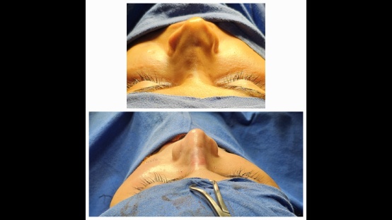 Rhinoplasty Before and After