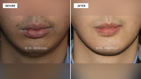 Chin Implant before and after photos