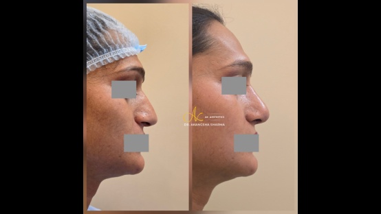 Rhinoplasty