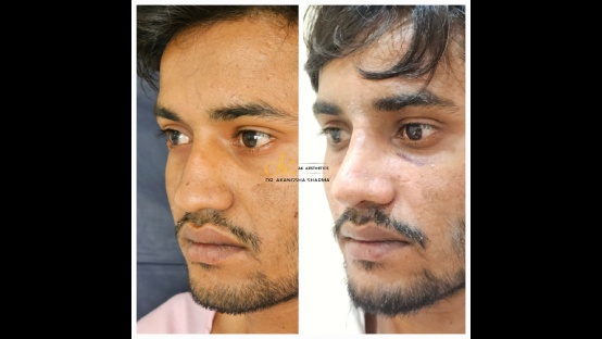 Rhinoplasty Before and After