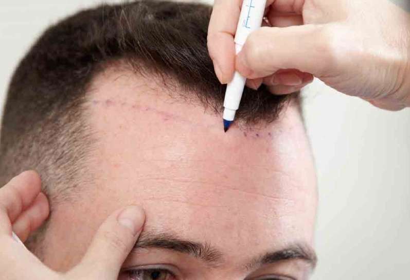 Best Hair Transplant in Jaipur at AK Aesthetics: Restore Hairline's Glory with Advanced Hair Techniques like FUT, FUE, Direct Technique.