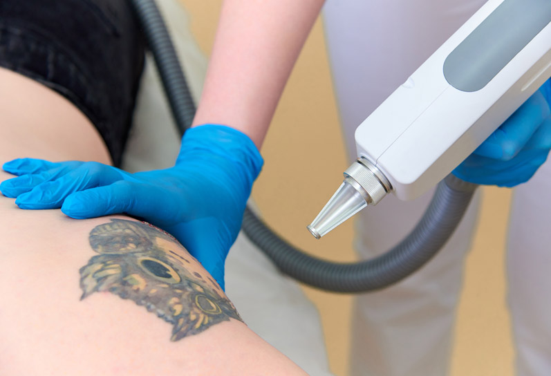 Tattoo Removal in Jaipur
