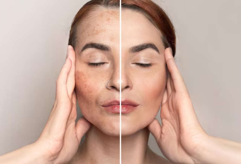 Anti Pigmentation