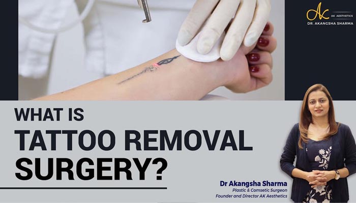 What is tattoo removal Surgery? Tattoo removal surgery in Jaipur | Dr Akangsha Sharma