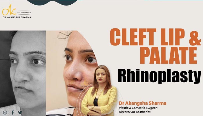 Cleft lip and palate rhinoplasty | Dr Akangsha Sharma