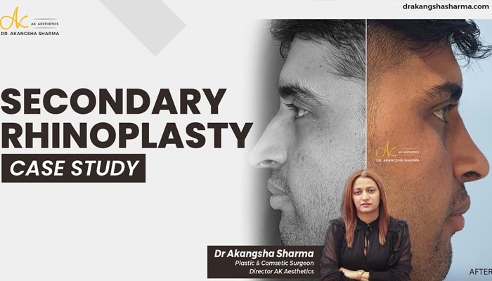 .Secondary Rhinoplasty Case Study | Dr Akangsha Sharma