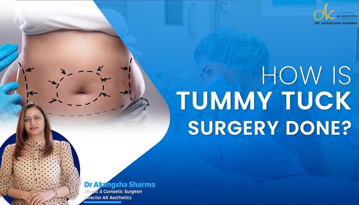 How is tummy tuck surgery done? | Tummy Tuck Surgery 