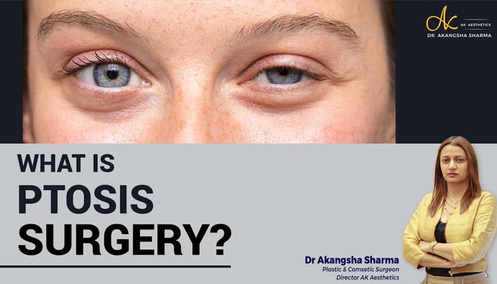 What is ptosis surgery?